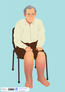 Man with oedema illustration