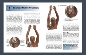 Coursework example - Thoracic Outlet Syndrome (textbook mockup) using CT data